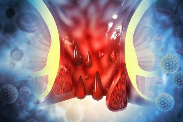 Hemorrhoids (piles)