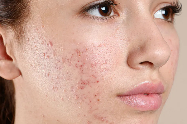 Acne