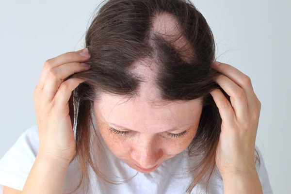 Alopecia