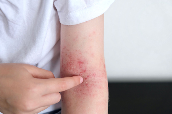 Eczema