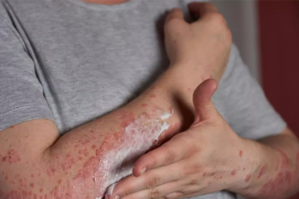 Lichen Planus
