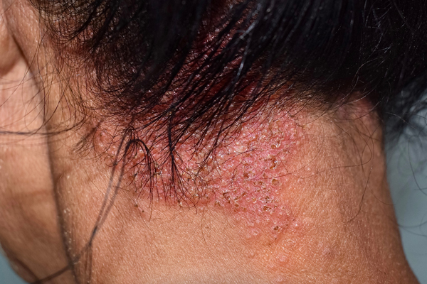 Psoriasis