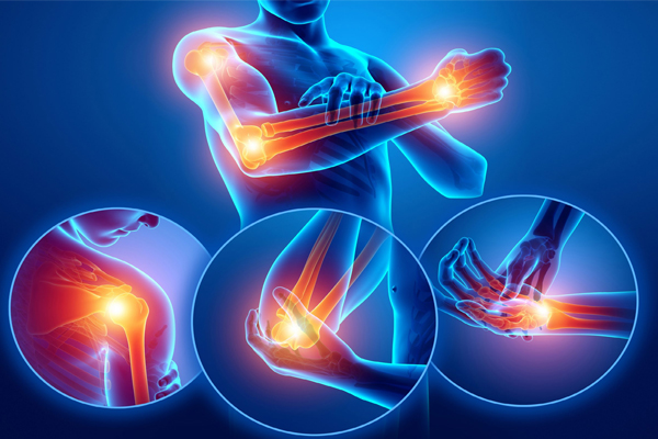 Rheumatoid Arthritis