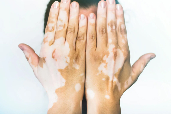 Vitiligo