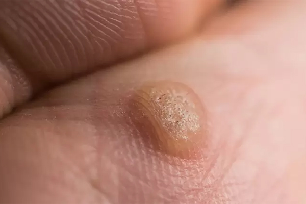 Warts