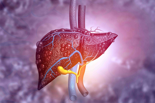 Liver Cirrhosis