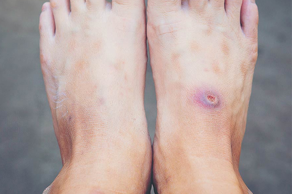 Gangrene
