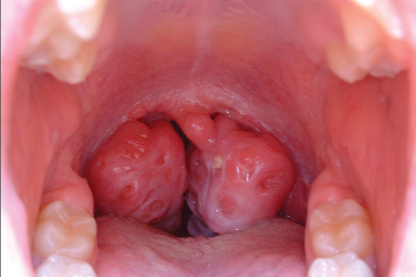 Enlarged and Recurrent Tonsils