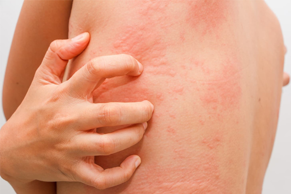 Urticaria